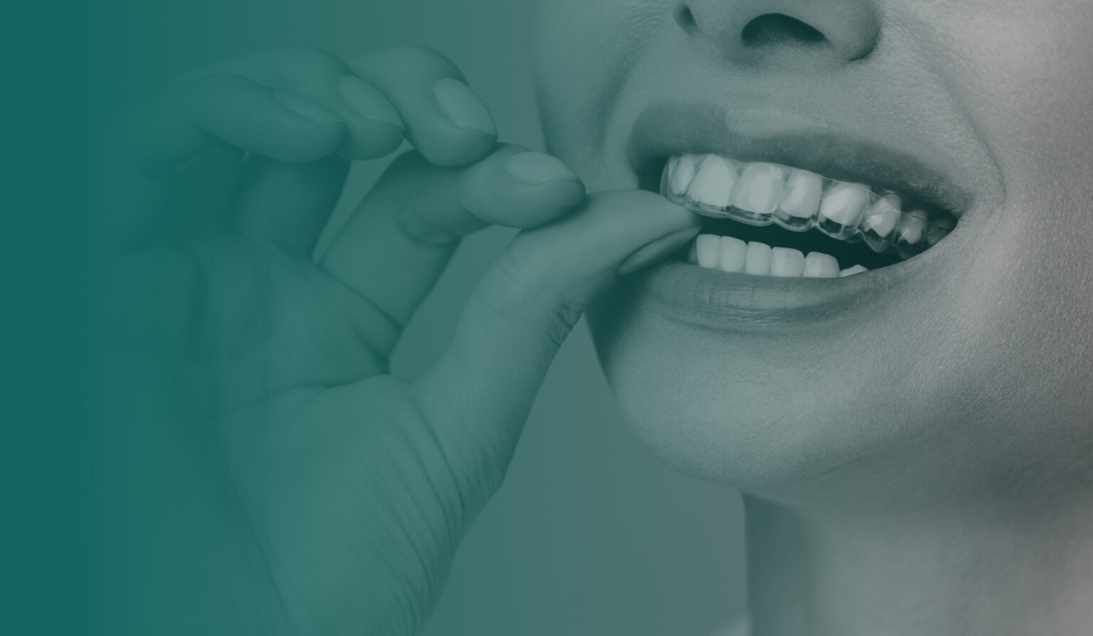 The Invisalign®  Treatment From  Straight Smile Studio  in the Harrisburg– Carlisle Metro Area 